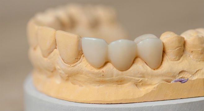 Металлокерамический мостовидный протез фото на зубах